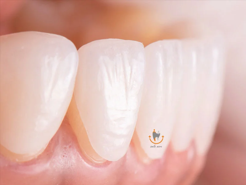 برداشتن لمینت دندان از دلایل تا نحوه اجرا