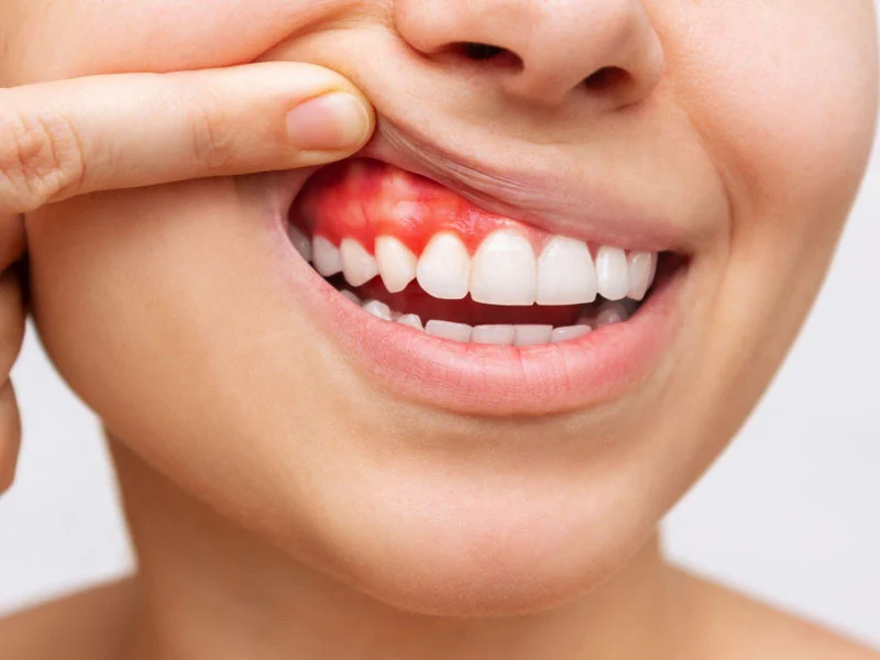 عفونت لثه بعد از کامپوزیت دندان
