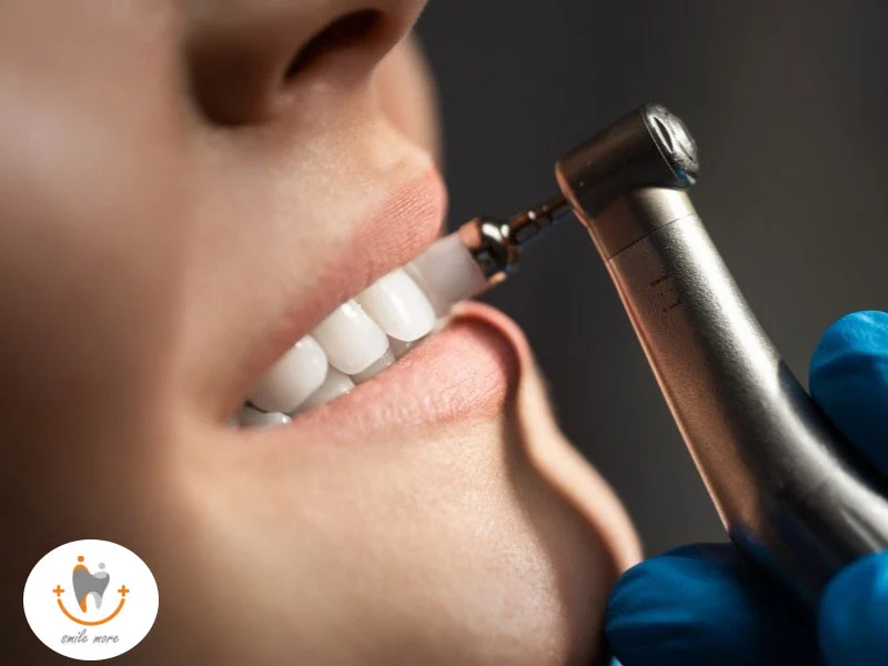 آیا لمینت دندان عصب کشی شده امکان دارد