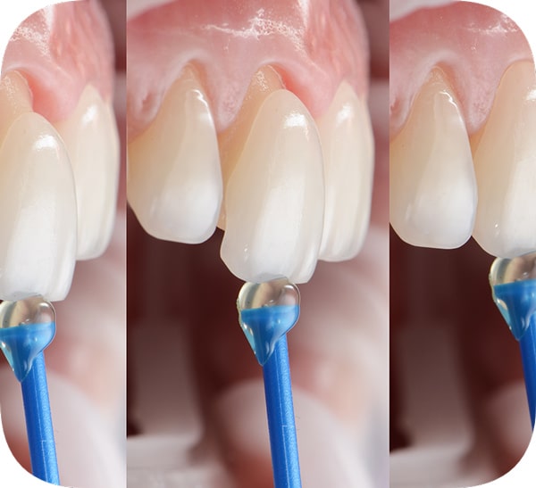 لمینت دندان جلو