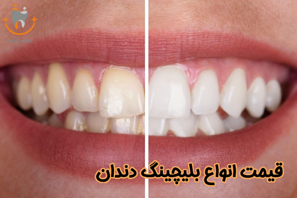 قیمت انواع بلیچینگ دندان
