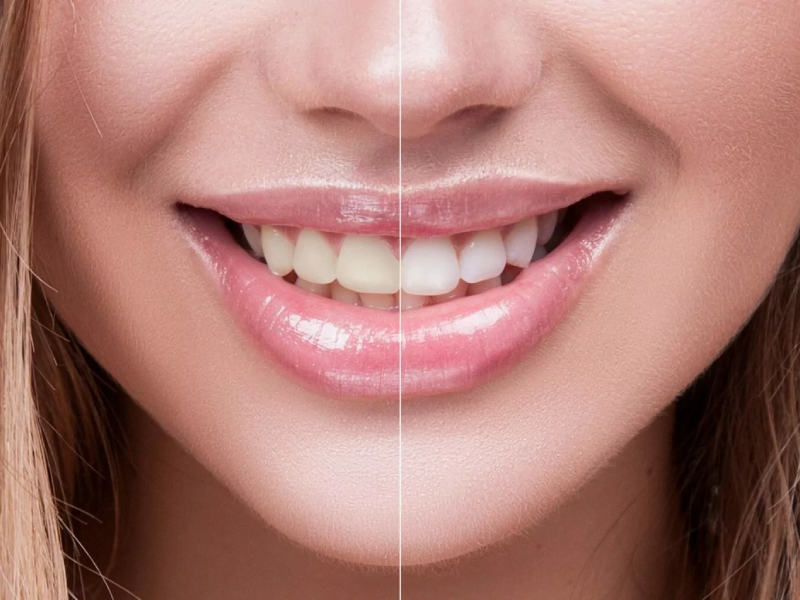 عکس قبل و بعد بلیچینگ دندان