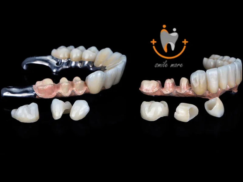 تفاوت کامپوزیت ونیر و لمینت سرامیکی؛ جامع ترین مقایسه