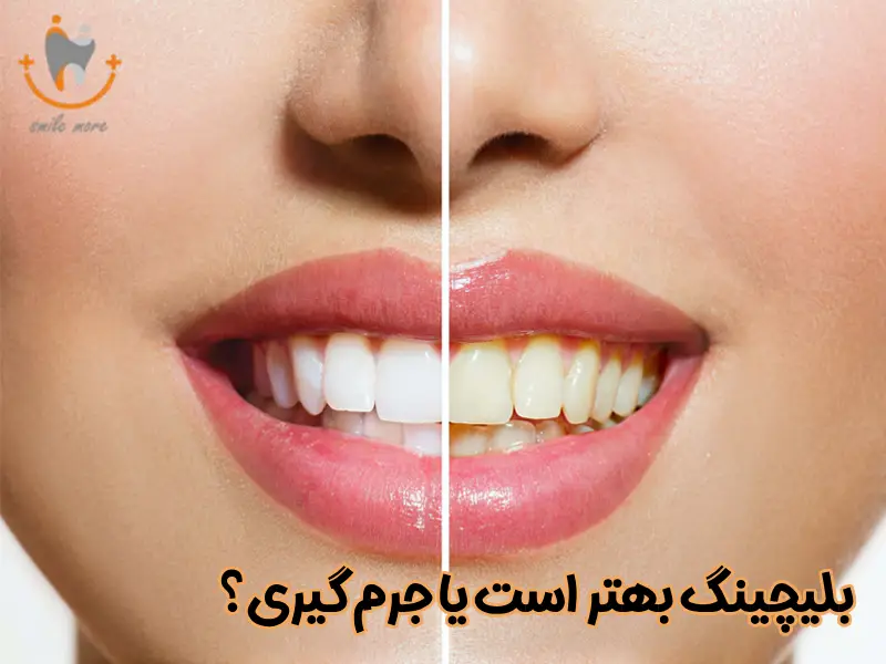 بلیچینگ دندان بهتر است یا جرم گیری دندان
