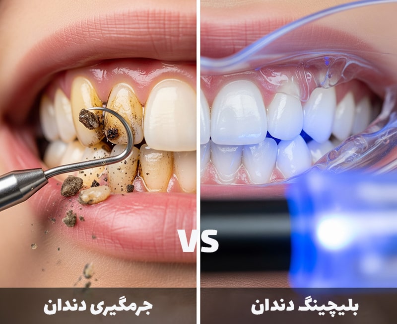 جرمگیری یا بلیچینگ دندان