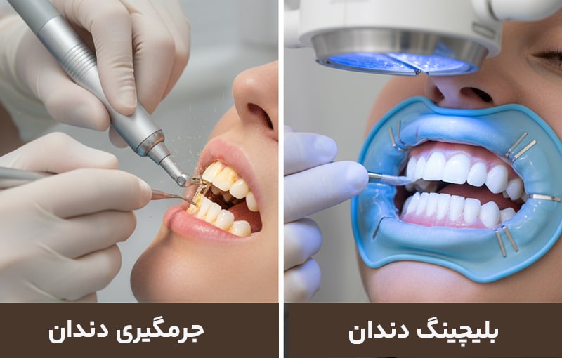 جرمگیری بهتره یا بلیچینگ دندان
