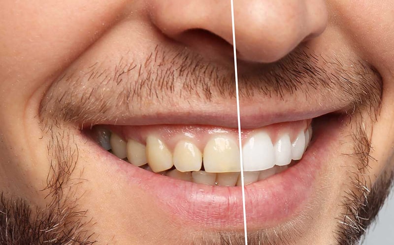 بهترین روش های زیبایی دندان