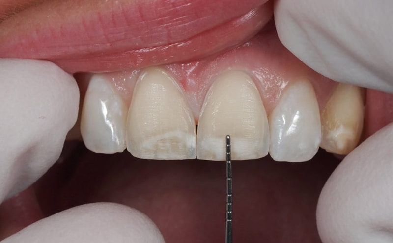 بهترین روش های زیبایی دندان