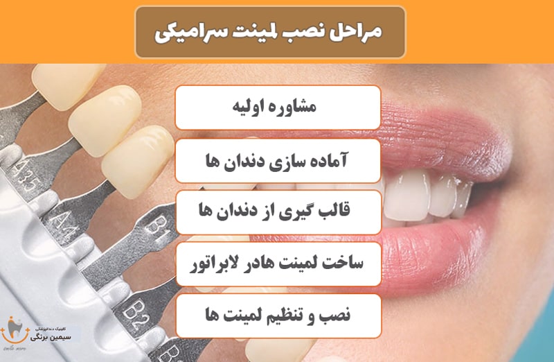 مراحل نصب لمینت سرامیکی