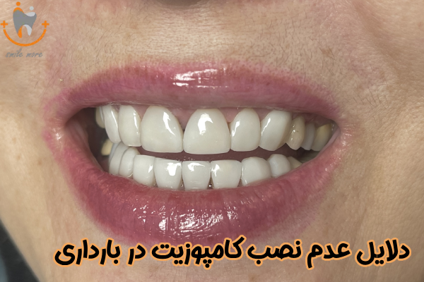 دلایل عدم نصب کامپوزیت در بارداری