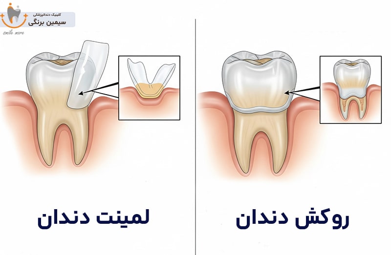 تفاوت لمینت و روکش دندان
