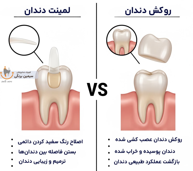 فرق لمینت با روکش زیرکونیا