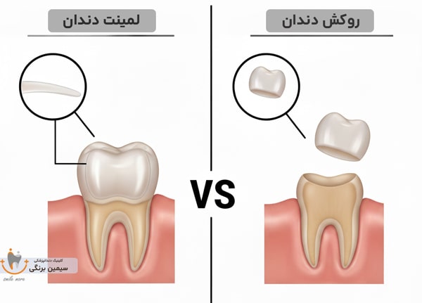 روکش بهتره یا لمینت