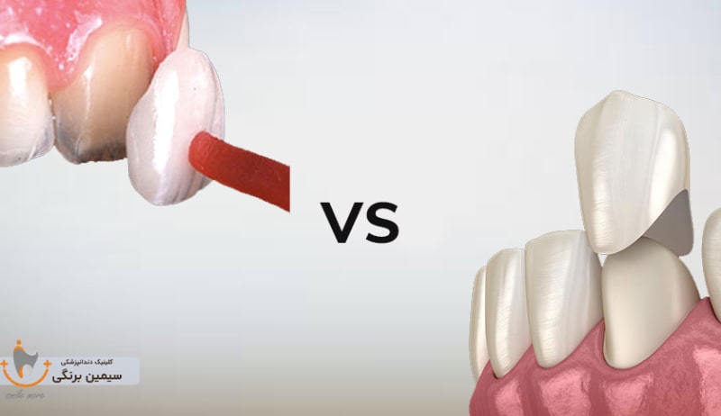 لمینت یا روکش دندان کدام بهتره؟