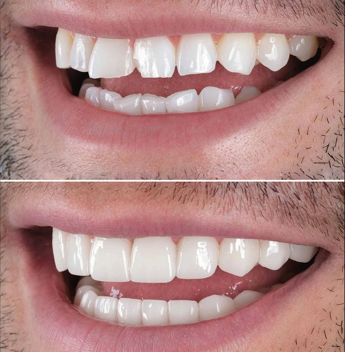 لمینت سرامیکی دندان