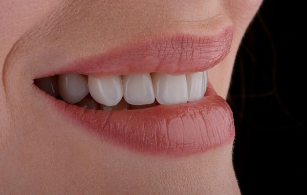 لمینت سرامیکی دندان