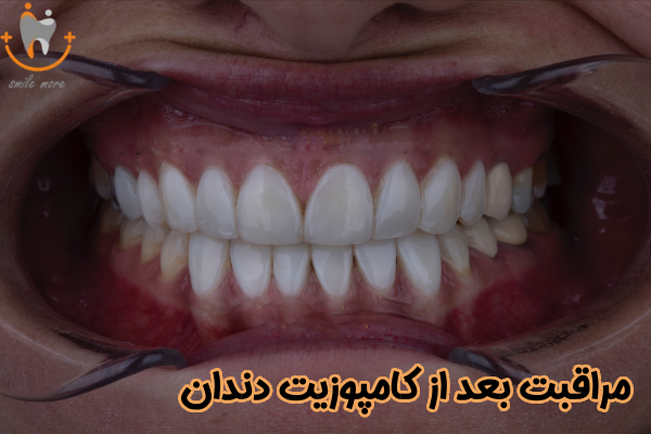 مراقبت بعد از کامپوزیت