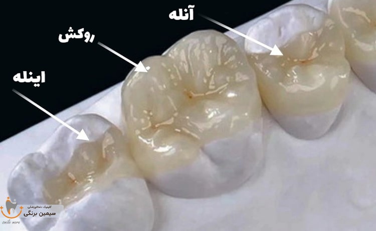 اینله و انله دندان