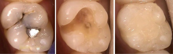 پر کردن تاج دندان