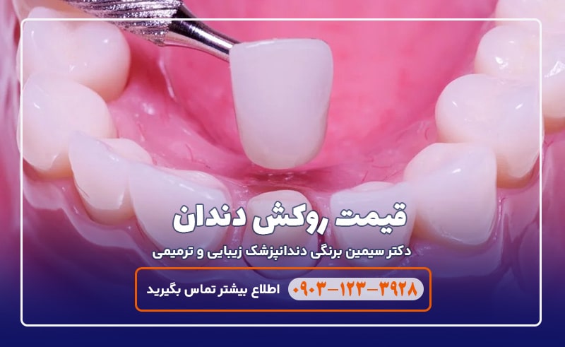 قیمت انواع روکش دندان در تهران