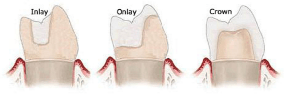 اینله و آنله دندان چیست