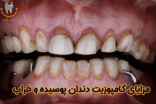 مزایای کامپوزیت دندان پوسیده و خراب