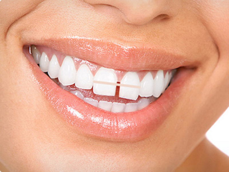 بستن فاصله بین دندان ها