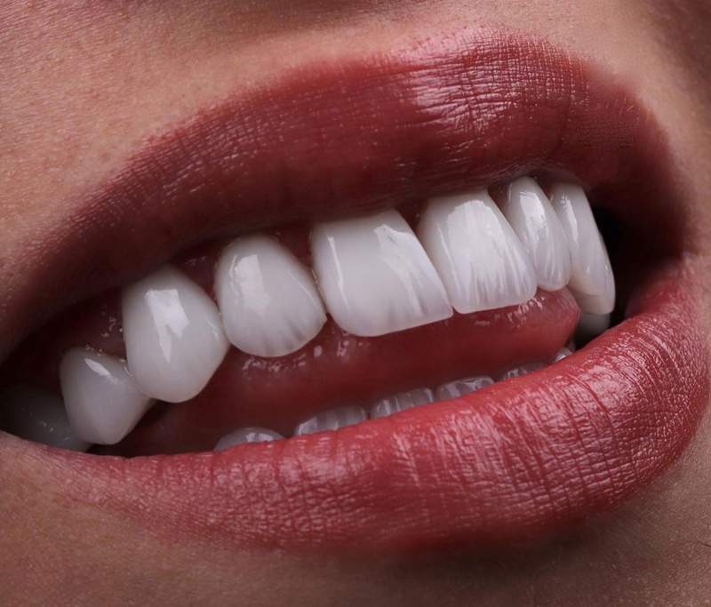 هزینه لمینت سرامیکی دندان