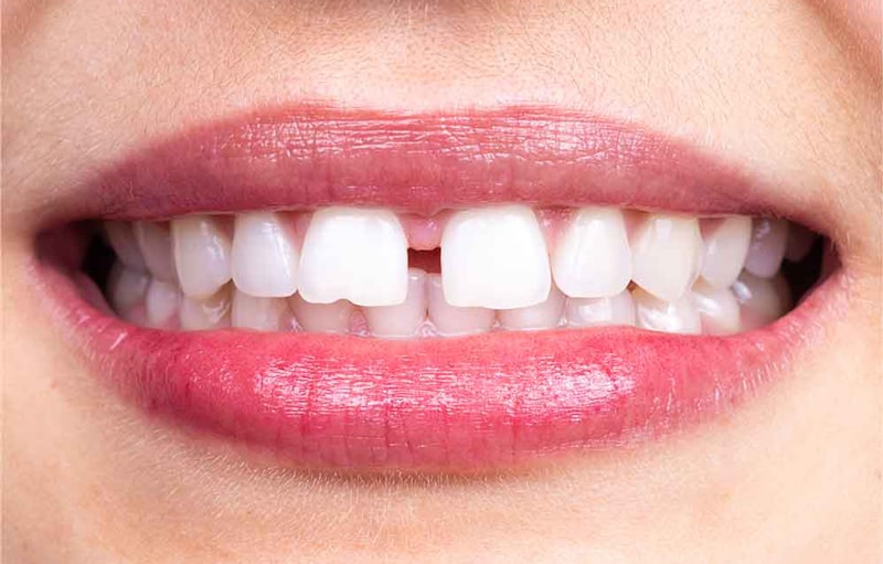 بستن فاصله بین دندان ها