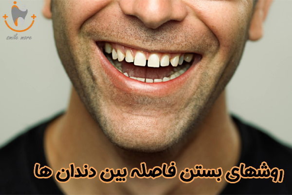 روش های بستن فاصله بین دندان ها