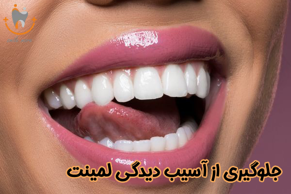 جلوگیری از آسیب دیدگی لمینت