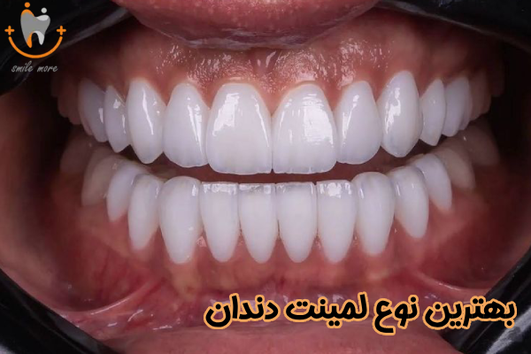 بهترین نوع لمینت