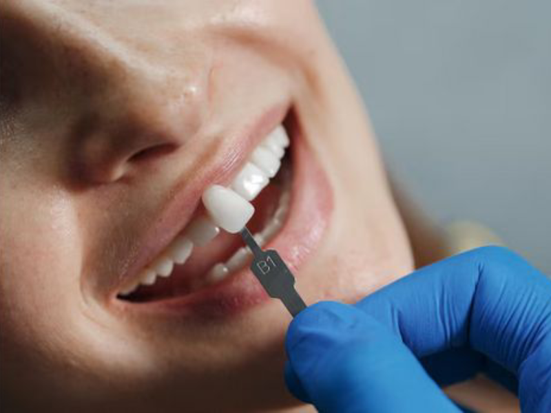 بهترین برند لمینت دندان