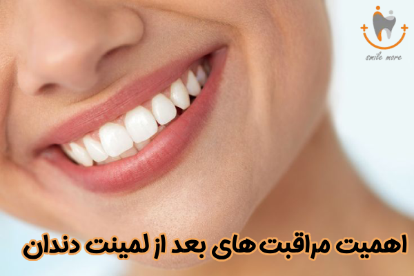 اهمیت مراقبت بعد از لمینت دندان