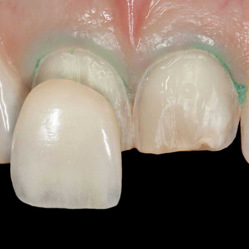 میزان تراش دندان برای لمینت
