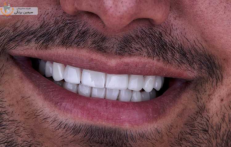 مراقبت های بعد از لمینت دندان