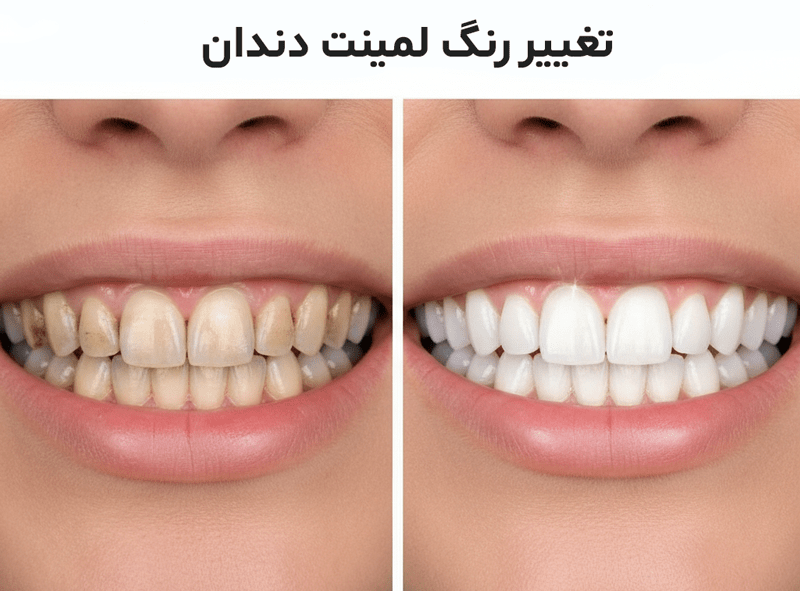 تغییر رنگ لمینت دندان