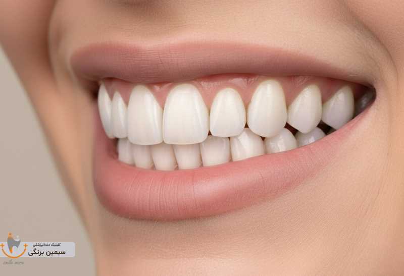 بهترین برند لمینت دندان