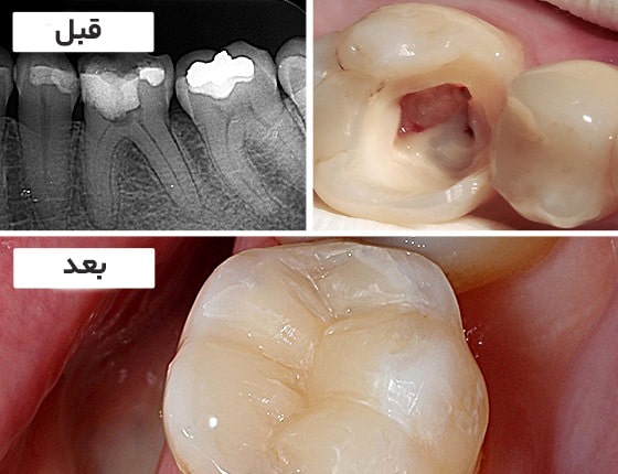 هزینه عصب کشی دندان