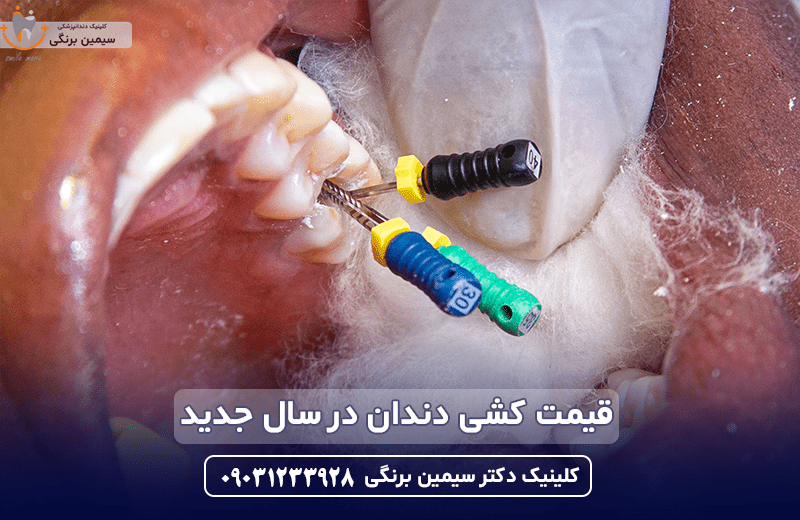 قیمت عصب کشی دندان در تهران