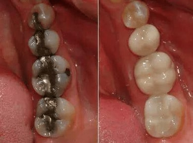قیمت پر کردن دندان با مواد سفید