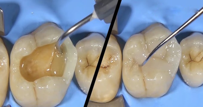 قیمت پر کردن دندان
