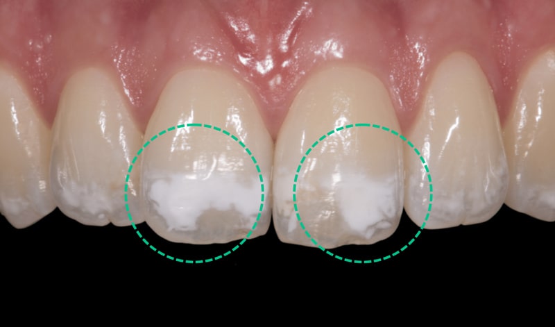 تغییر رنگ دندان