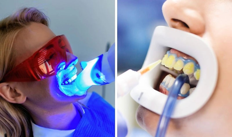 درمان تغییر رنگ دندان