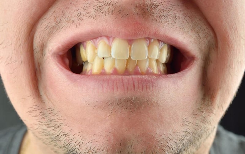 علت زرد شدن دندان