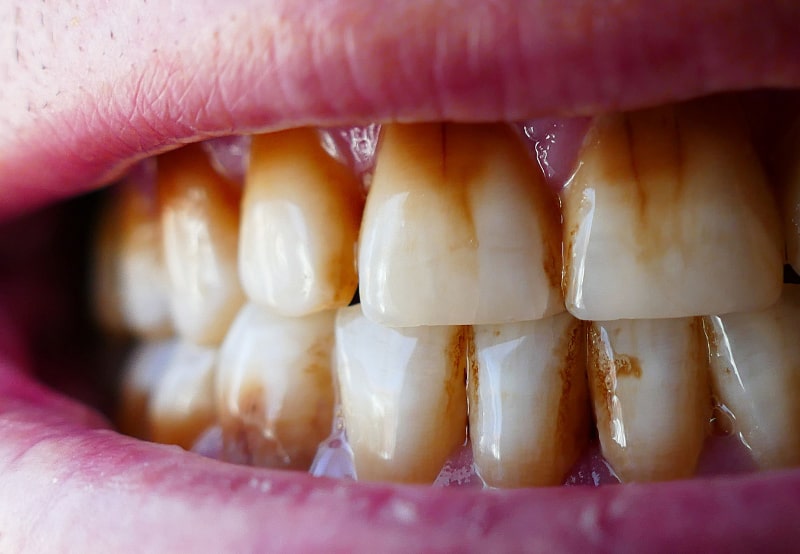 علت تغییر رنگ دندان