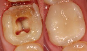 انواع درمان ریشه دندان