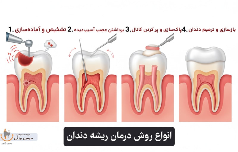 انواع روش های درمان ریشه دندان