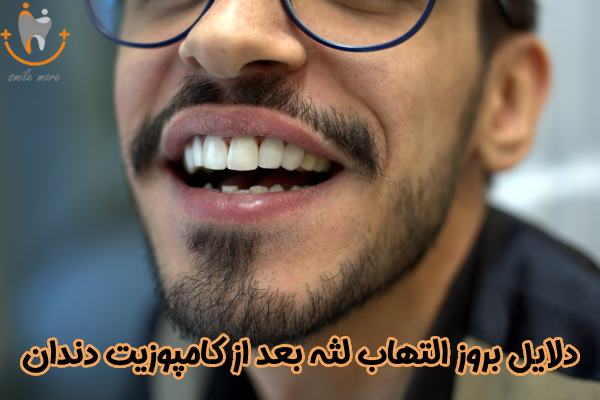دلایل بروز التهاب لثه بعد از کامپوزیت