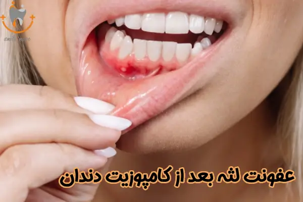 عفونت لثه بعد از کامپوزیت دندان